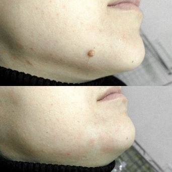 Before and after the application Skincell Pro
