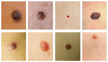 The most common spots on the skin – is the neo and the papilloma virus (warts)