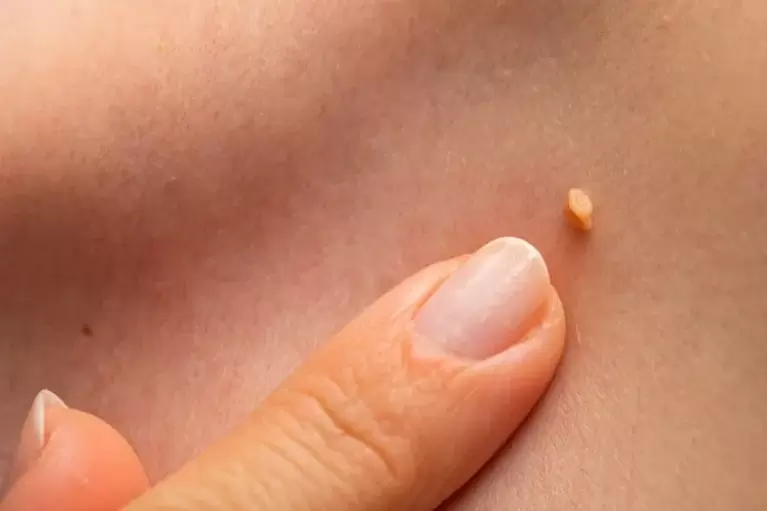 Papillomas on the skin