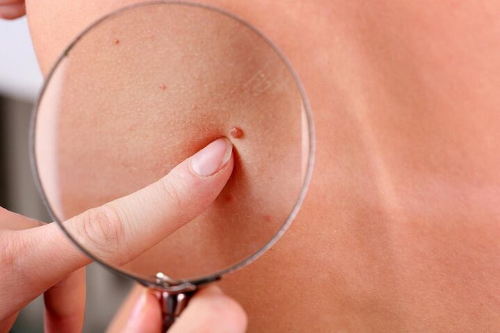 how to get rid of warts on the face