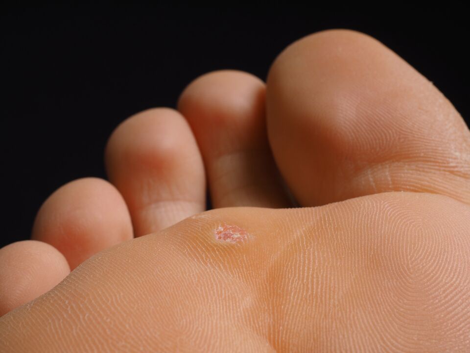 what are plantar warts like