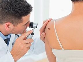 the doctor examines the papilloma about recommending removal with medication