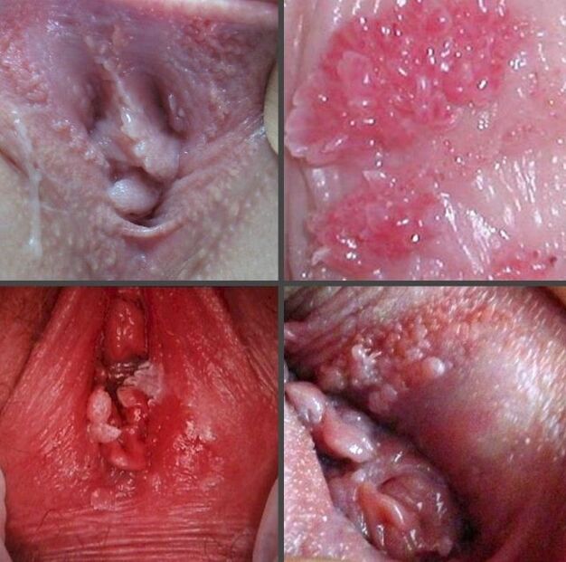 Closed papilloma on the vagina