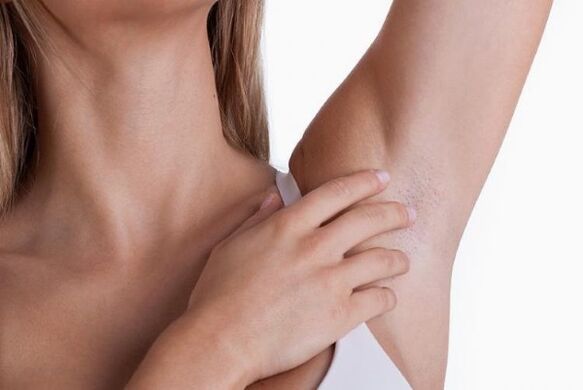 papilloma under a woman's armpit