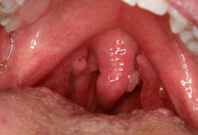 papilloma in the esophagus
