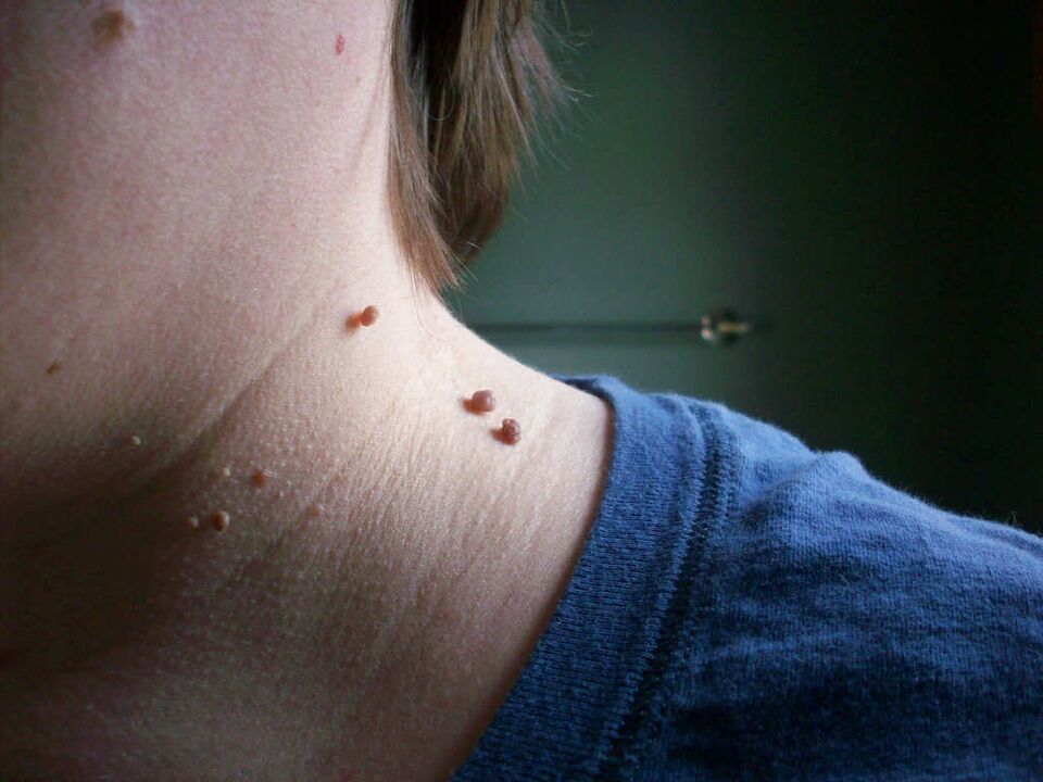 Papilloma on the neck how to treat