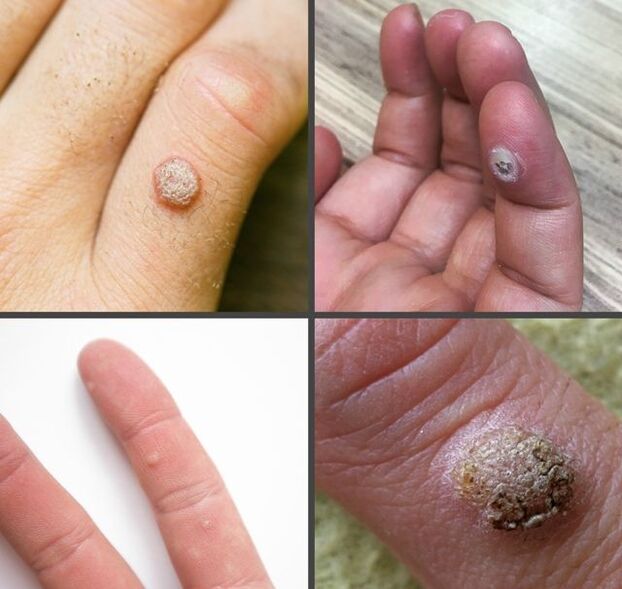 A common type of wart on the finger