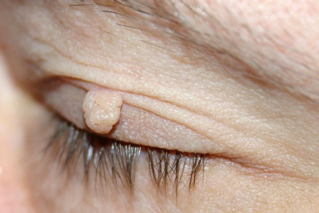 symptoms of papilloma on the eyelids