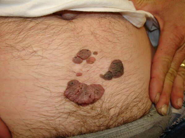 papilloma on the stomach of a man