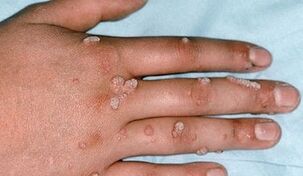 types of warts and their methods of removal