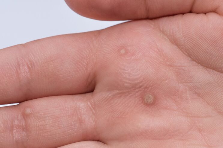 Flat warts on the palms of the hands